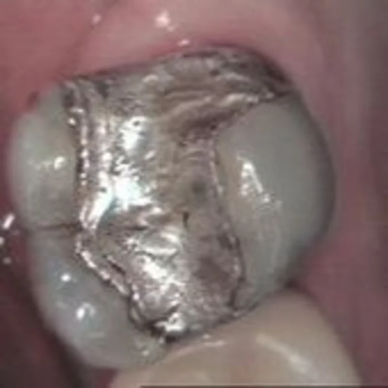 Close-up von einer Amalgamfüllung