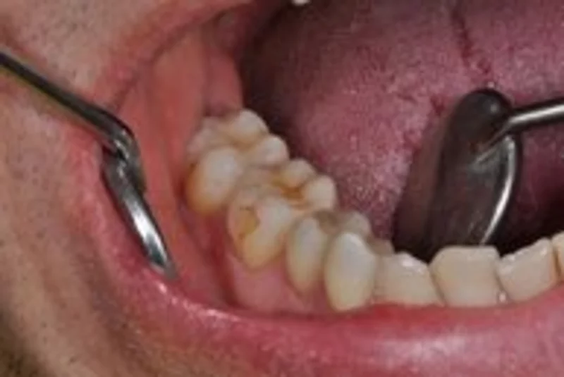 Abb. 6: Die fertige Restauration im Mund an 46.