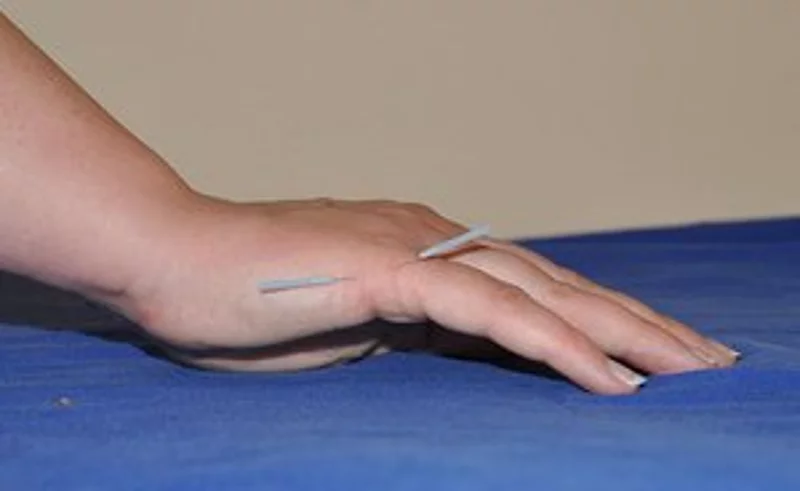 Hand mit Akupunkturnadeln