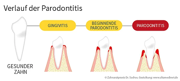 Schema von einem Verlauf einer Parodontitis